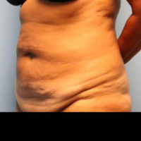 Before photo of a woman who had a tummy tuck