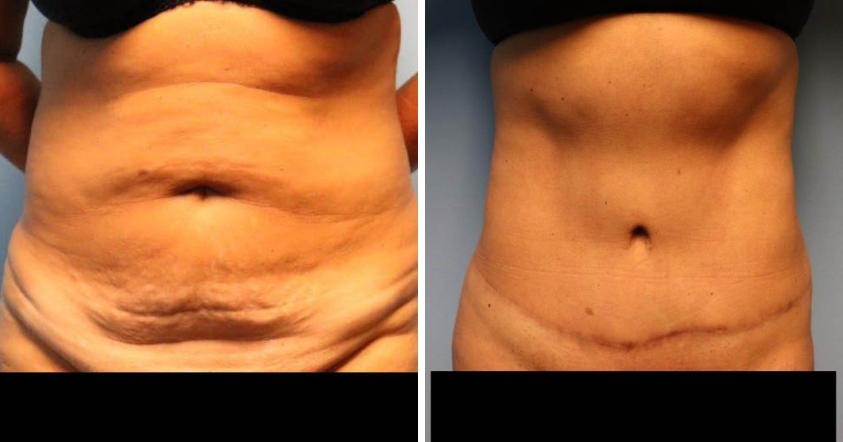 Before and after photos from a woman who received a tummy tuck