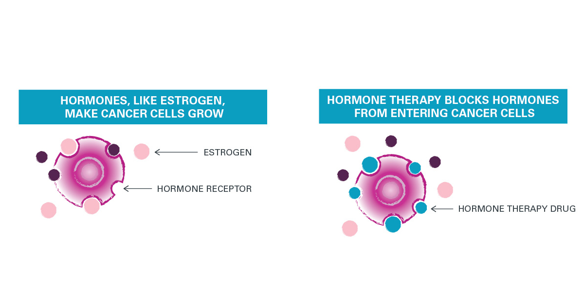 Breast cancer study tests pairing hormone therapy with immunotherapy