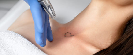 tattoo removal