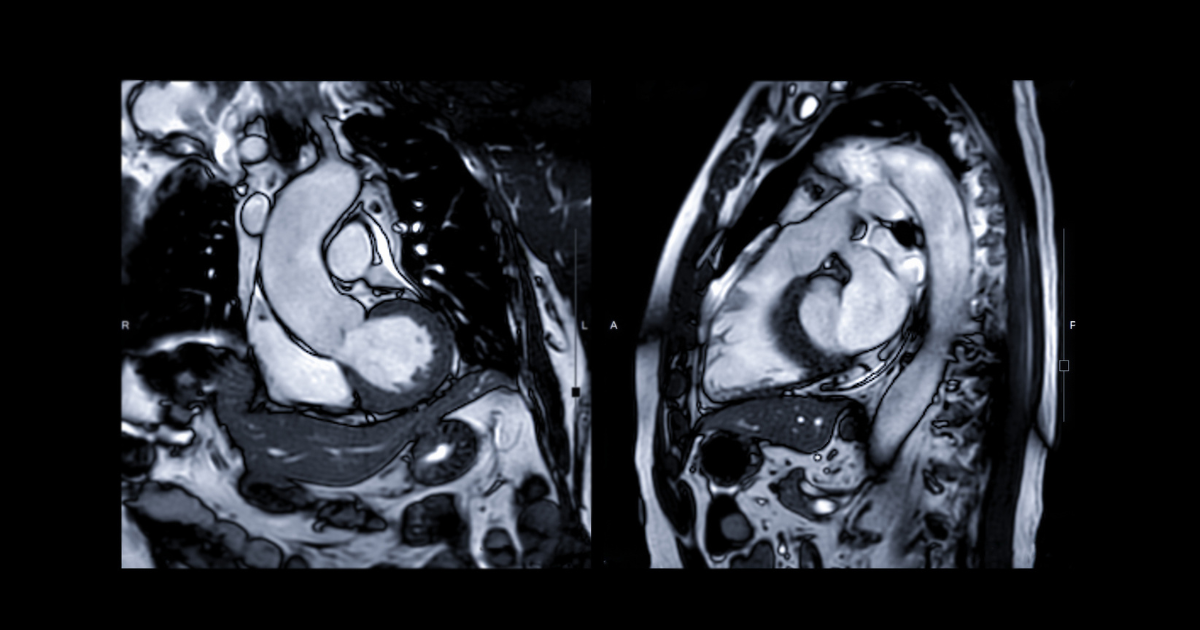 Cardiac MRI image