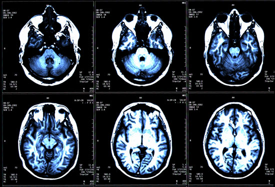 Signs and Symptoms of Multiple Sclerosis