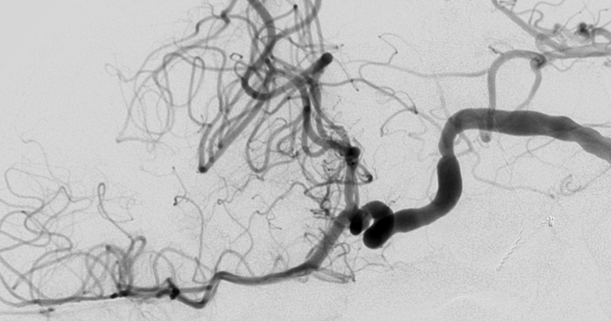 CT scan