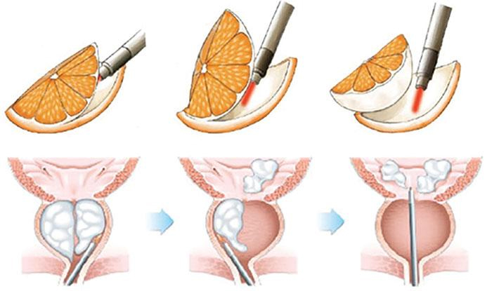 HoLEP uses a laser and camera (scope) to remove the entire portion of the prostate that is blocking urine flow