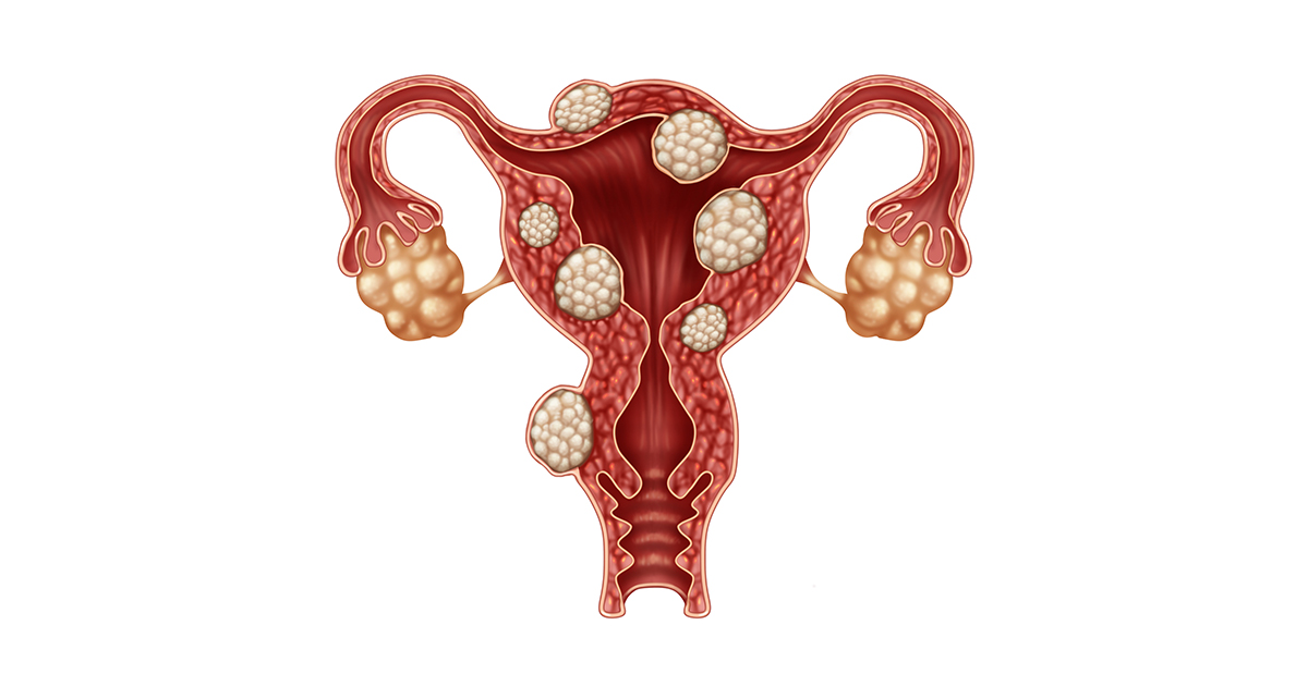 Fibroids