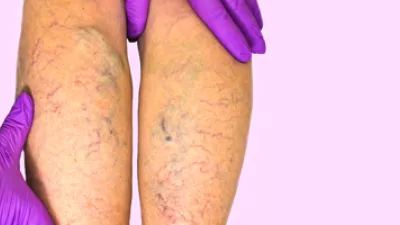 picture of a doctor examining a patient's varicose veins