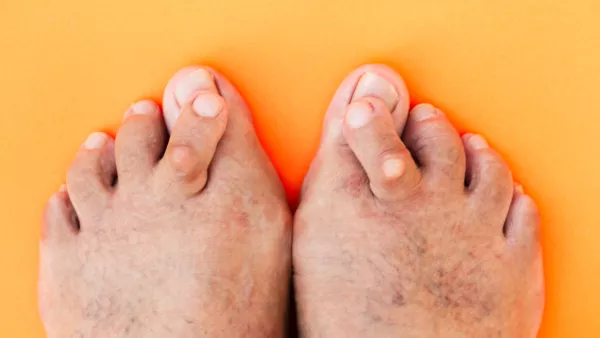 Close up of man's feet with hammertoes