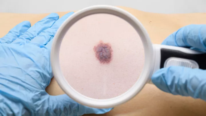 Magnifying glass looking at mole