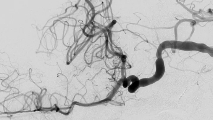 CT scan