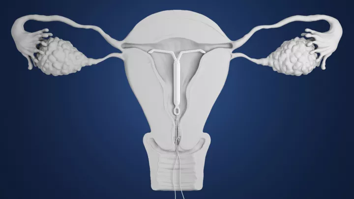 Medical illustration of the female reproductive system with an IUD