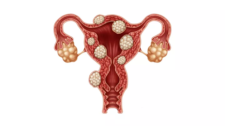 Fibroids